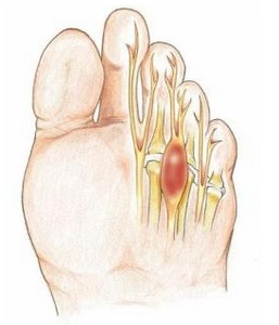 Diagnosticul și tratamentul mortonei de la Neuroma, traumatolog-ortopedist Petrosyan a