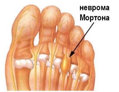 Diagnosticul și tratamentul mortonei de la Neuroma, traumatolog-ortopedist Petrosyan a