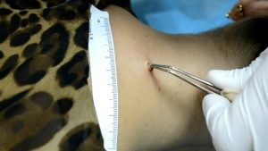Spitz anyajegyet tünetei, kezelése, és a fényképek (anyajegyek) Spitz Nevus tünetek, kezelés és fotók