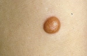 Spitz Nevus tünetei, kezelése, és a kép (fotó) Spitz Nevus tünetek, kezelés és fotók