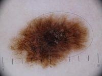 Nevus Spitz (spits) - mederm - dermatovenerologie dermatolog, venerolog, skinhead în Belgorod