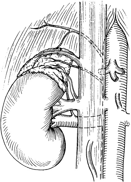 Neuroblastomul, ganglioneuroma