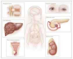 Neuroblastoma Gyermekek