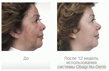 Obagi nu-derm®