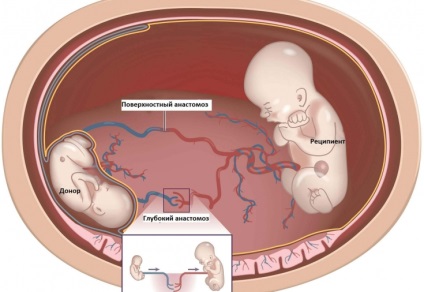 Patologia intrauterină periculoasă a sindromului de transfuzie sanguină feto-fetală