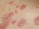 Chromophytosis humán kezelésben, a tünetek, okok (tünetek) Chromophytosis humán kezelésben, a tünetek, okok