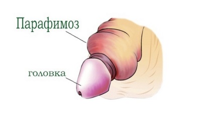 Parafimoza la baieti si barbati este ceea ce este de a trata, schema de parafimoza in casa