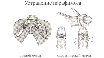 Parafimoza la baieti si barbati este ceea ce este de a trata, schema de parafimoza in casa