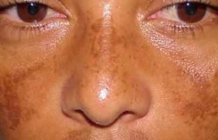 Pigmentarea pielii pe picioare cauzează tulburări de sinteză a melaninei