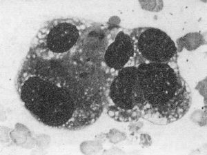 A pikkelyes elszarusodó fotó neorogovevayuschy és a rák kezelésére és prognózis