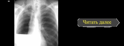 Pneumoperitoneu în clinica de tuberculoză