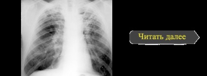 Pneumoperitoneum a tuberkulózis klinikai