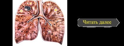 Pneumoperitoneu în clinica de tuberculoză