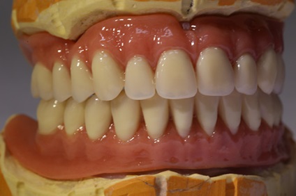 Implantarea completă a dinților
