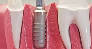 Implantarea completă a dinților
