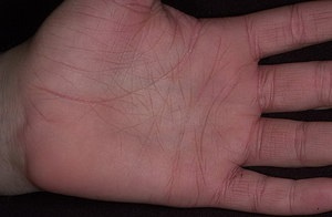 Cauze de mâncărime de ce palmele mâinilor sunt zgâriate, metode de tratament