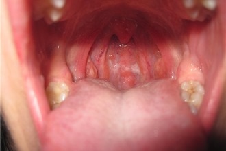 Tulburări și chisturi în gât și tuse uscată - ce și cum să tratezi