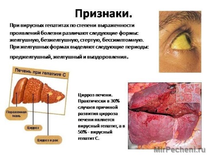 Simptomele bolii hepatice - semne de boală și tratament