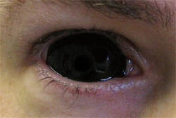 Lentile de contact sclere da sau nu, despre lentile, ochelari și corecția vederii