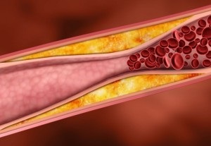 Scleroza tratamentului vaselor cerebrale în străinătate