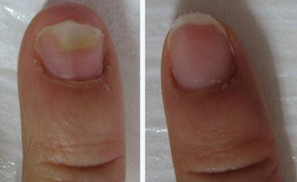 Sfaturi privind modul de vindecare a unei ciuperci de picior și unghii timp de o lună