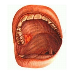 Üszög - tünetek és kezelés (a szájban, a nyelv), hogyan kell kezelni fekély, seb
