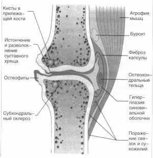 Scleroza subchondrală a bolii comune - cauze, simptome și tratament