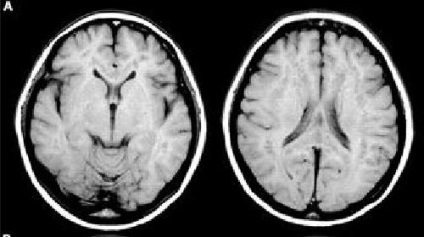 Tomografia capului