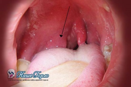 Тонзилит симптоми, лечение, независимо дали инфекциозен