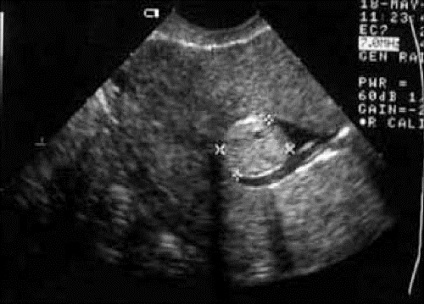 Transvesivă cu ultrasunete