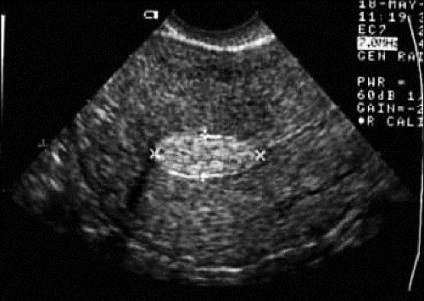 Transvesivă cu ultrasunete
