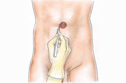 Îndepărtarea unei hernie a stomacului și indicații ale operației