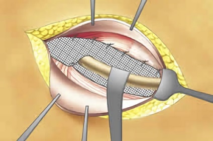 Îndepărtarea unei hernie a stomacului și indicații ale operației