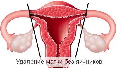 Îndepărtarea uterină fără ovare