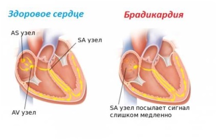 Bradicardie moderată ce este și cum să o tratezi