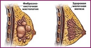 Mărirea sânilor cu mastopatie este o realitate sau o fantezie