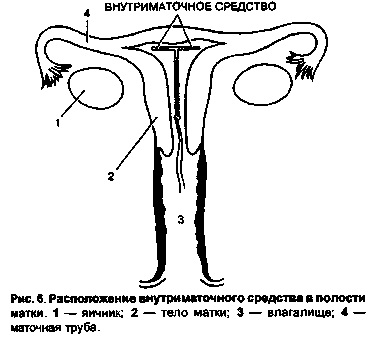 Dispozitive intrauterine