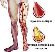 Boala arterelor periferice ale extremităților inferioare