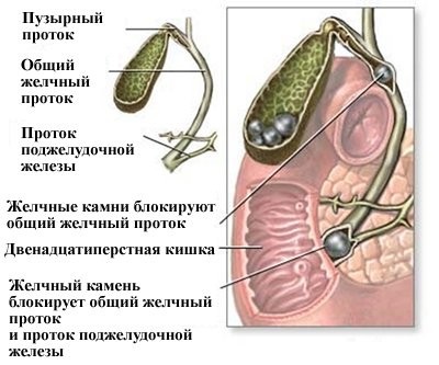 Boli colice cauze, semne, simptome, și de tratament