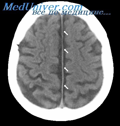 Mutism acinetic