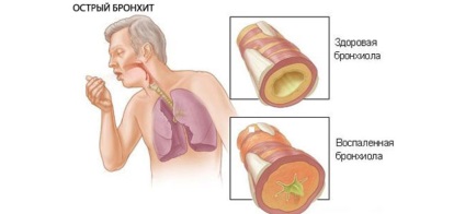 Indicatiile ciproletului cu antibiotice si efectele secundare