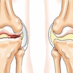 Recomandările complexe coloidale de la Arthro cu o hernie a coloanei vertebrale