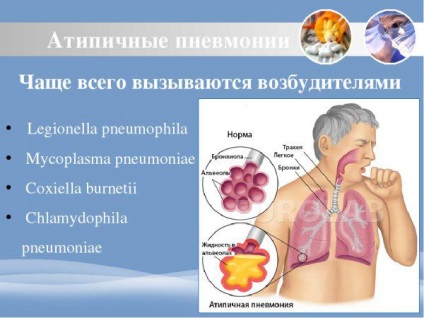 Atipice pneumonie simptome și tratament la adulți și copii fără antibiotice de temperatură, ceea ce este