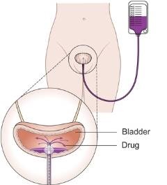 BCG în cancerul vezicii urinare - tratament în Israel, medicamentul best