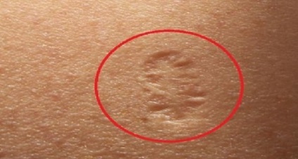 Felnőtt BCG oltást tuberkulózis elleni előtt és után 30 évvel, az olvasás, a képzés és ahol lehet, hogy (a bizonyság) Felnőtt BCG oltást tuberkulózis elleni előtt és után 30 évvel, az olvasás, a képzés és ahol lehet, hogy