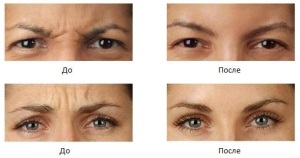 Botox, lantox, disport, efecte xeomin, efecte, tratament