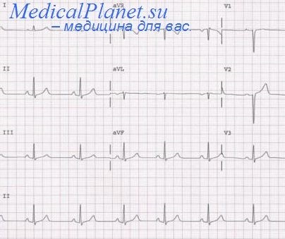 Sensibilitatea electrocardiografiei