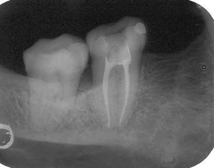 Revista dentară, articole, endodonție terapeutică și modernă, o nouă soluție la problemele vechi (bug-uri