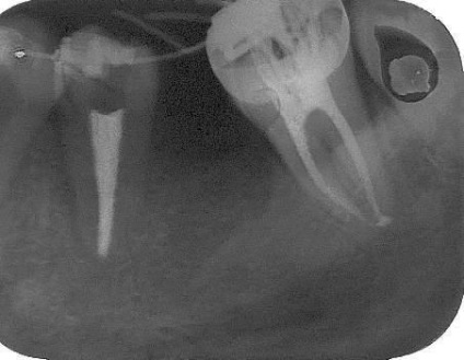 Revista dentară, articole, endodonție terapeutică și modernă, o nouă soluție la problemele vechi (bug-uri