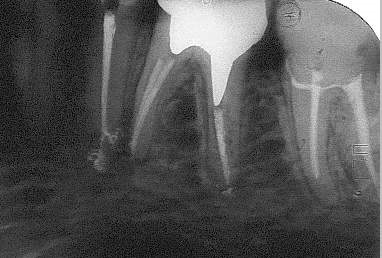 Revista dentară, articole, endodonție terapeutică, modernă, o nouă soluție la problemele vechi (bug-uri